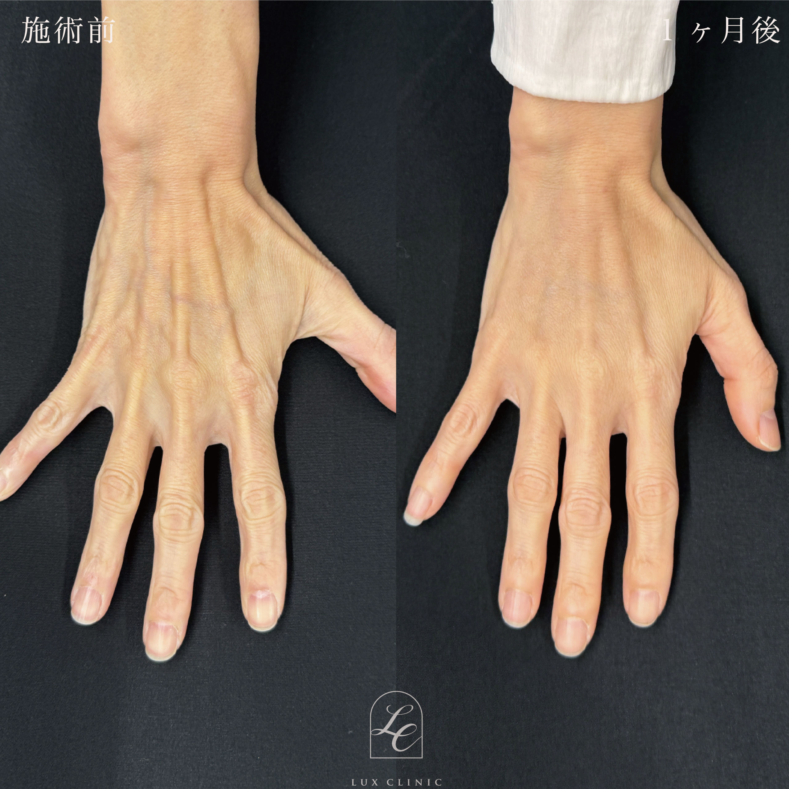コンデンスリッチ脂肪注入 ＜手の甲＞