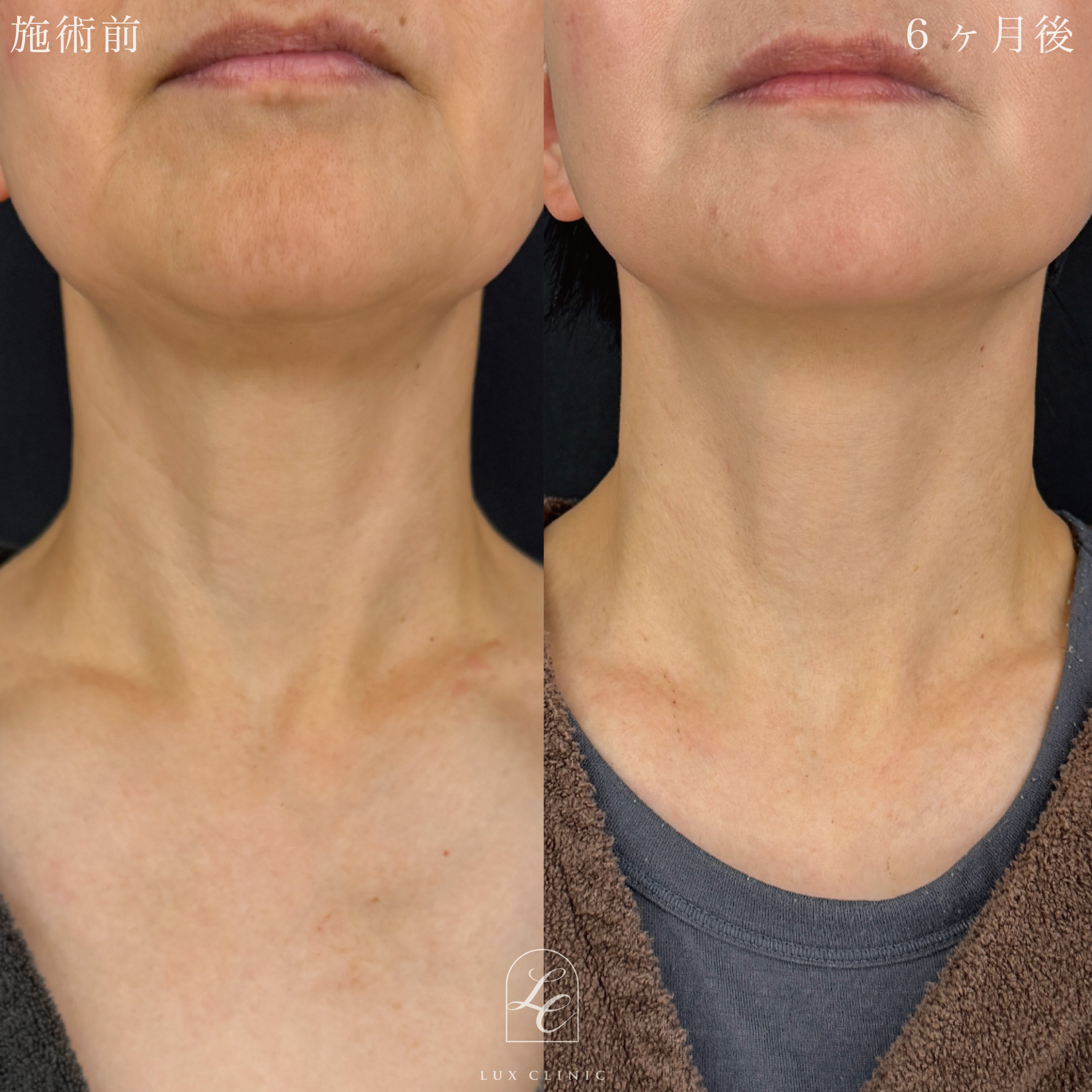 ディーププレーンフェイスネックリフト ＋ もみあげリフト ＋ コンデンスリッチ脂肪注入 ＜顔全体・首＞