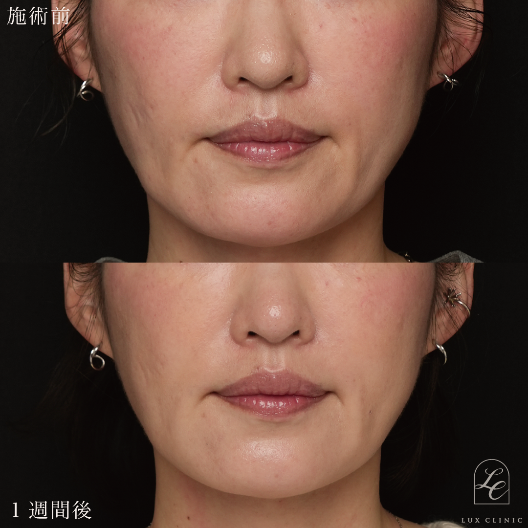 ヒアルロン酸（レスチレン 2本）＜口横＞