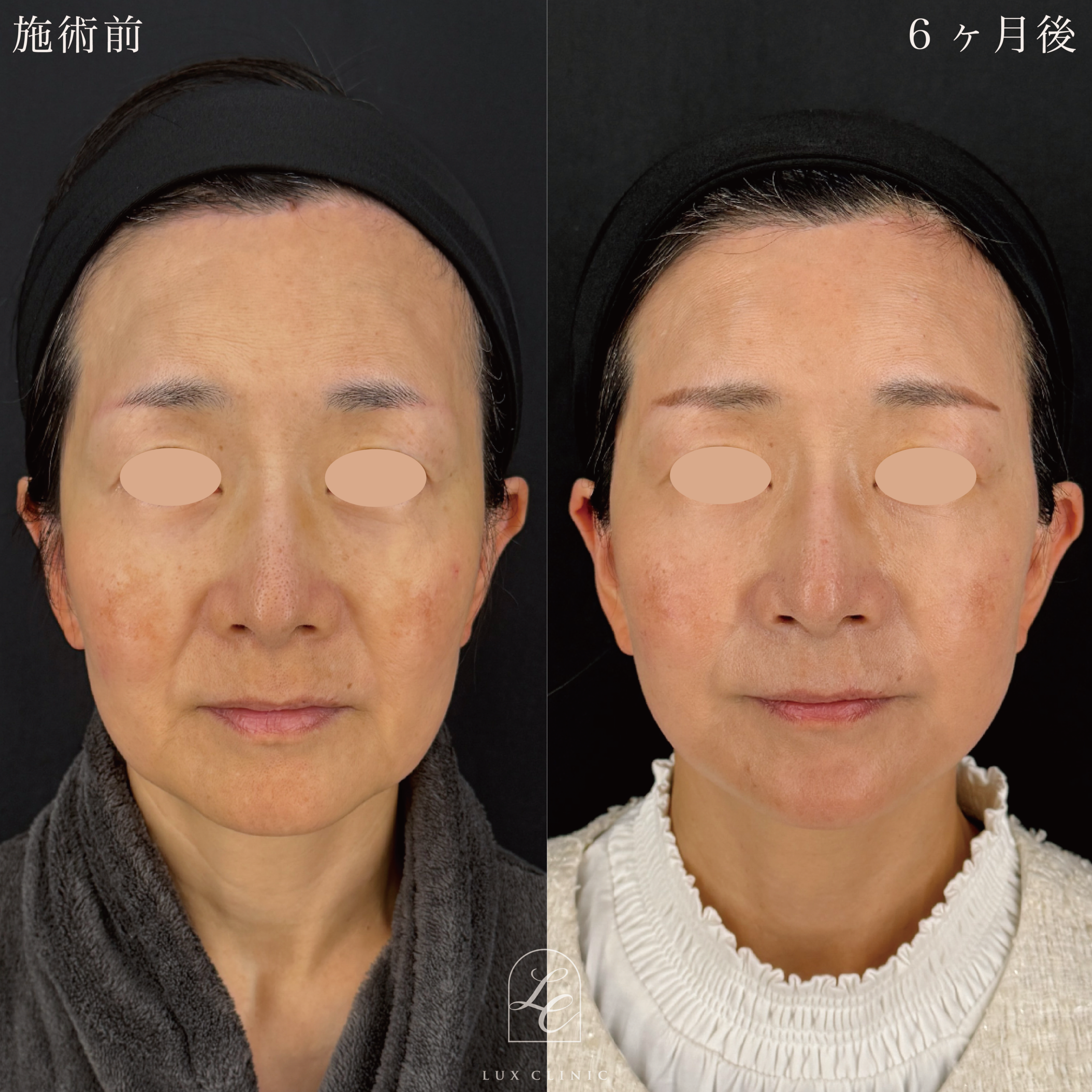 ディーププレーンフェイスネックリフト ＋ もみあげリフト ＋ コンデンスリッチ脂肪注入 ＜顔全体・首＞