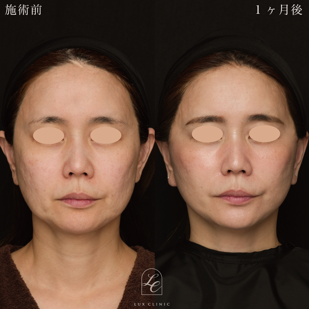 フェイスリフト