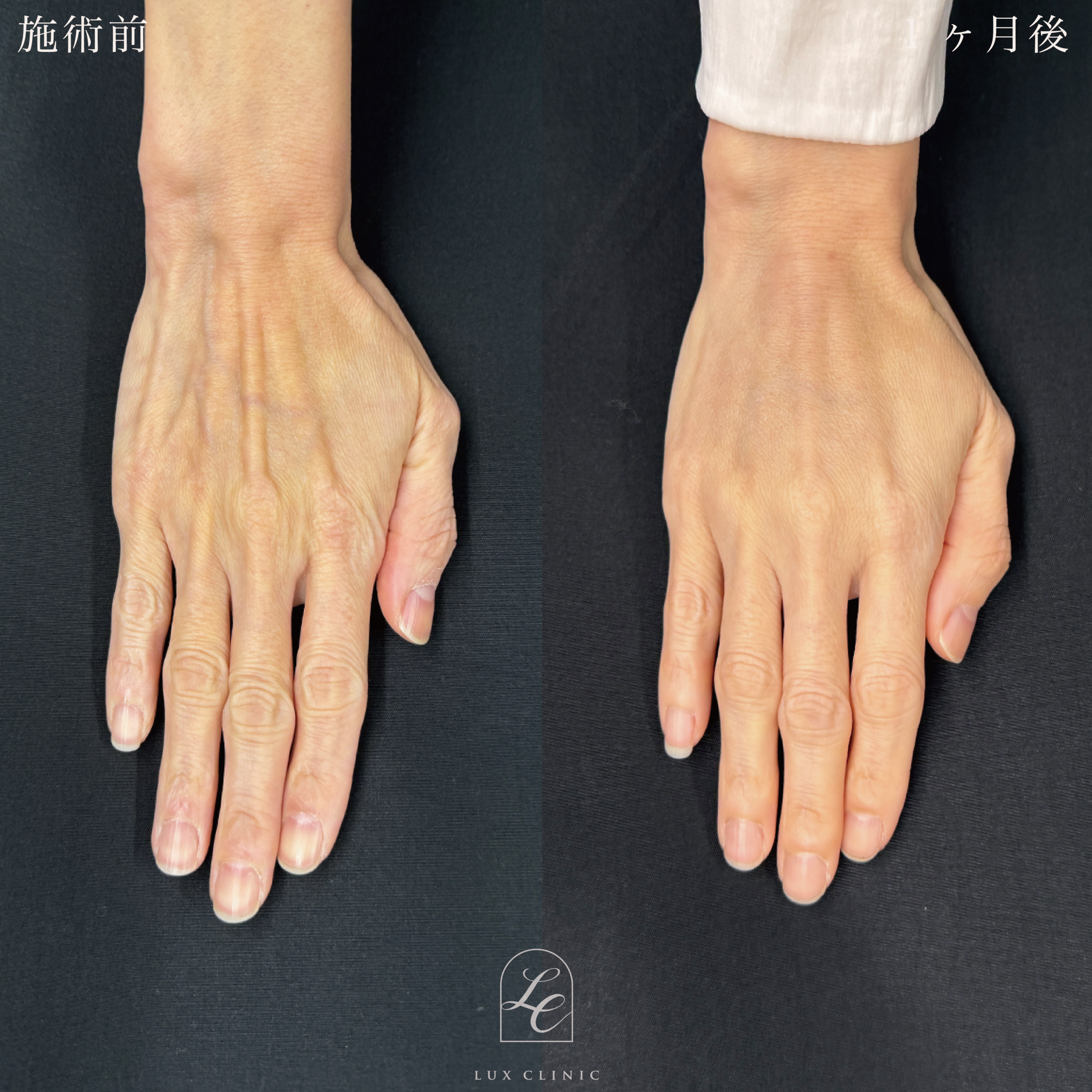 コンデンスリッチ脂肪注入 ＜手の甲＞