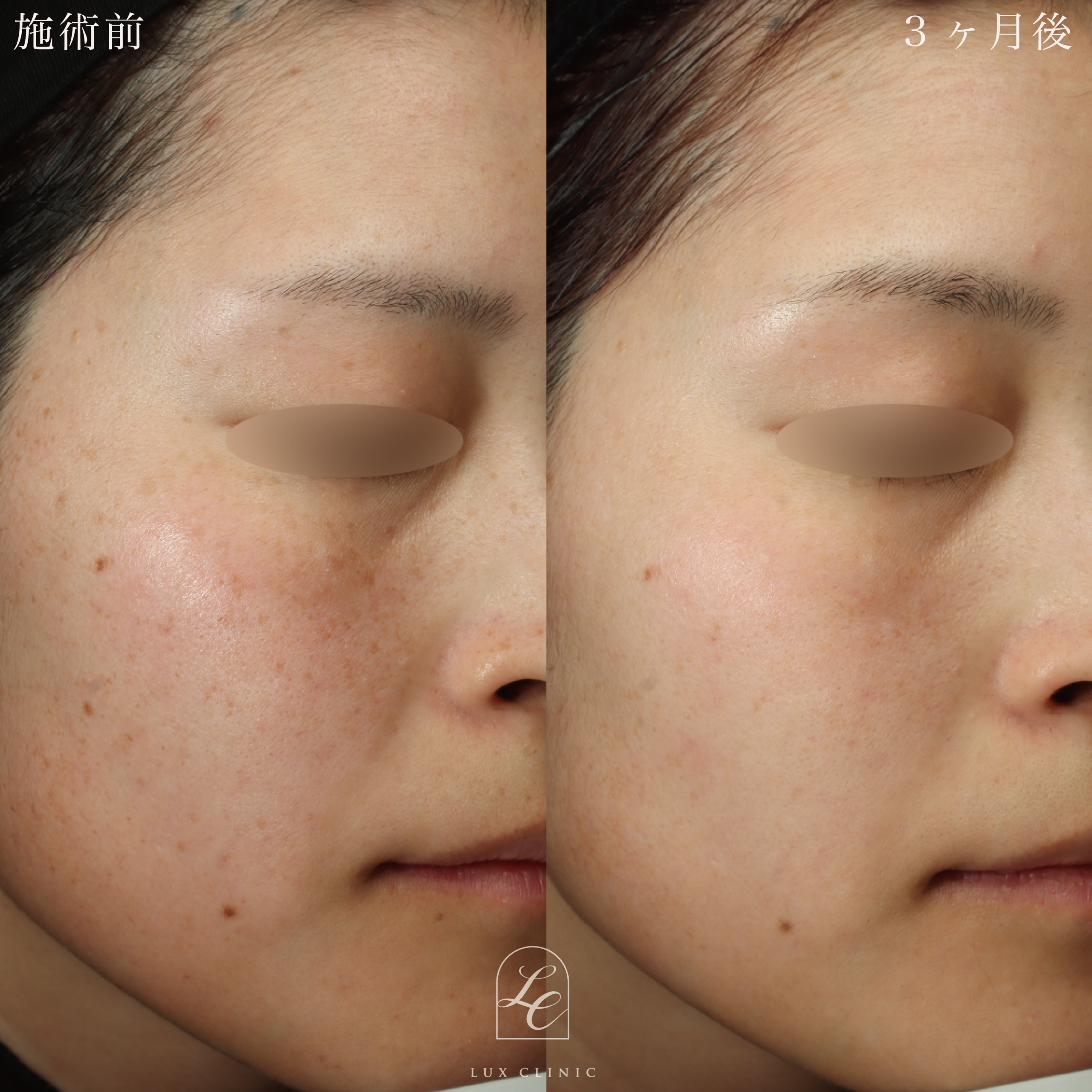 ディスカバリーピコプラス しみスポット照射＜顔全体＞1回