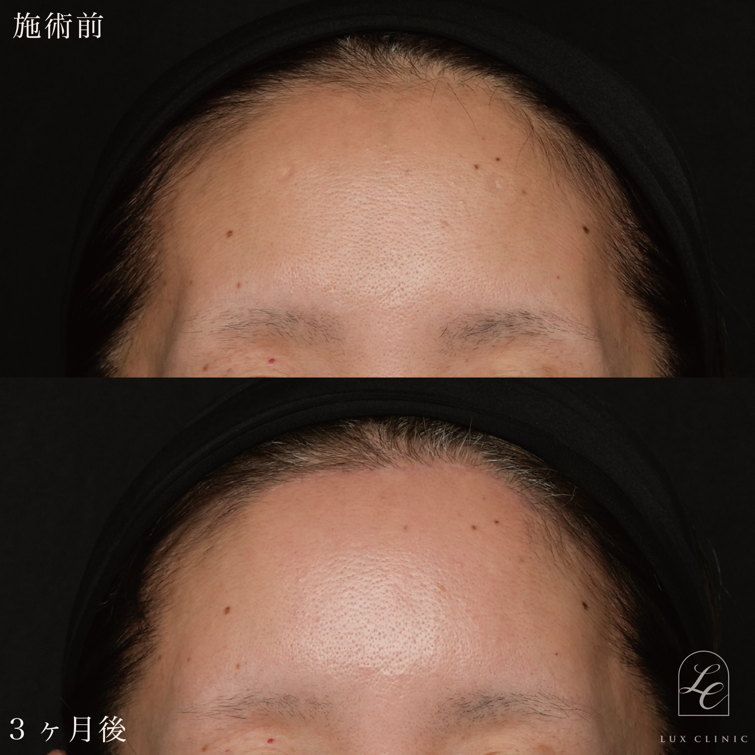 コンデンスリッチ脂肪注入 ＜顔全体・首＞＋前額リフト