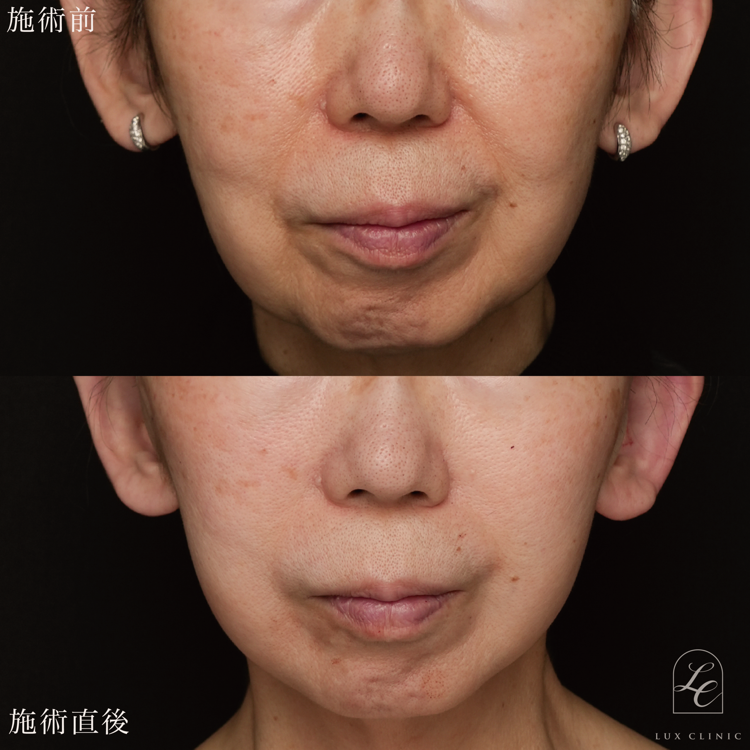 もみあげリフト