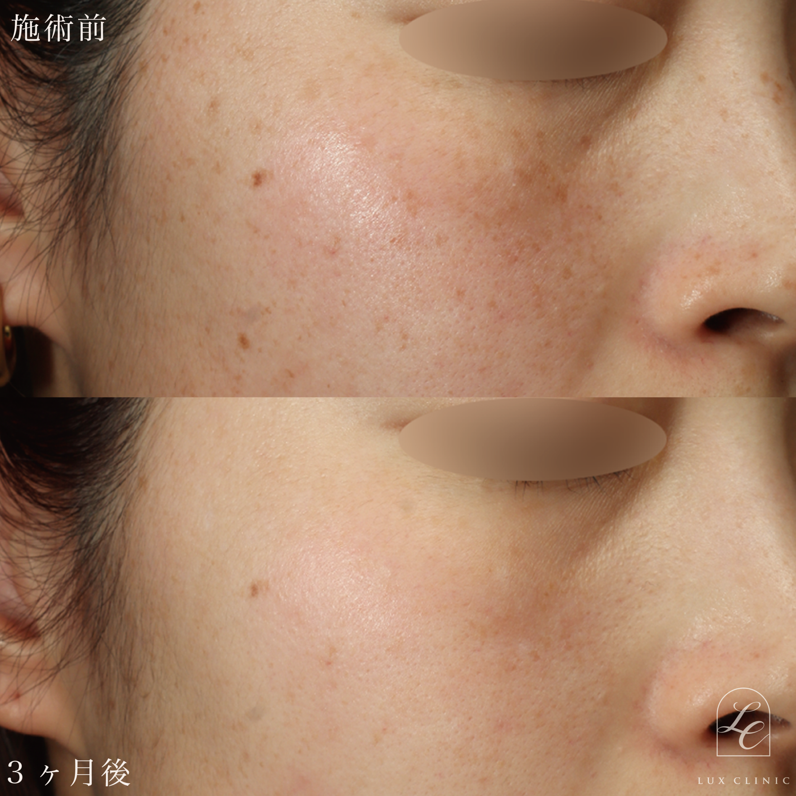 ディスカバリーピコプラス しみスポット照射＜顔全体＞1回