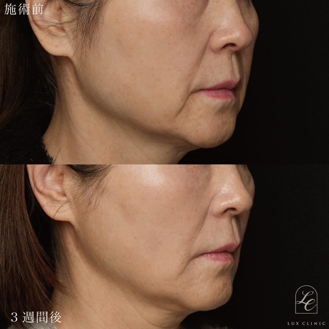 糸リフト（テスリフト 2本、カクテルリフト4本）＋ヒアルロン酸（レスチレン 2本）＜口横＞