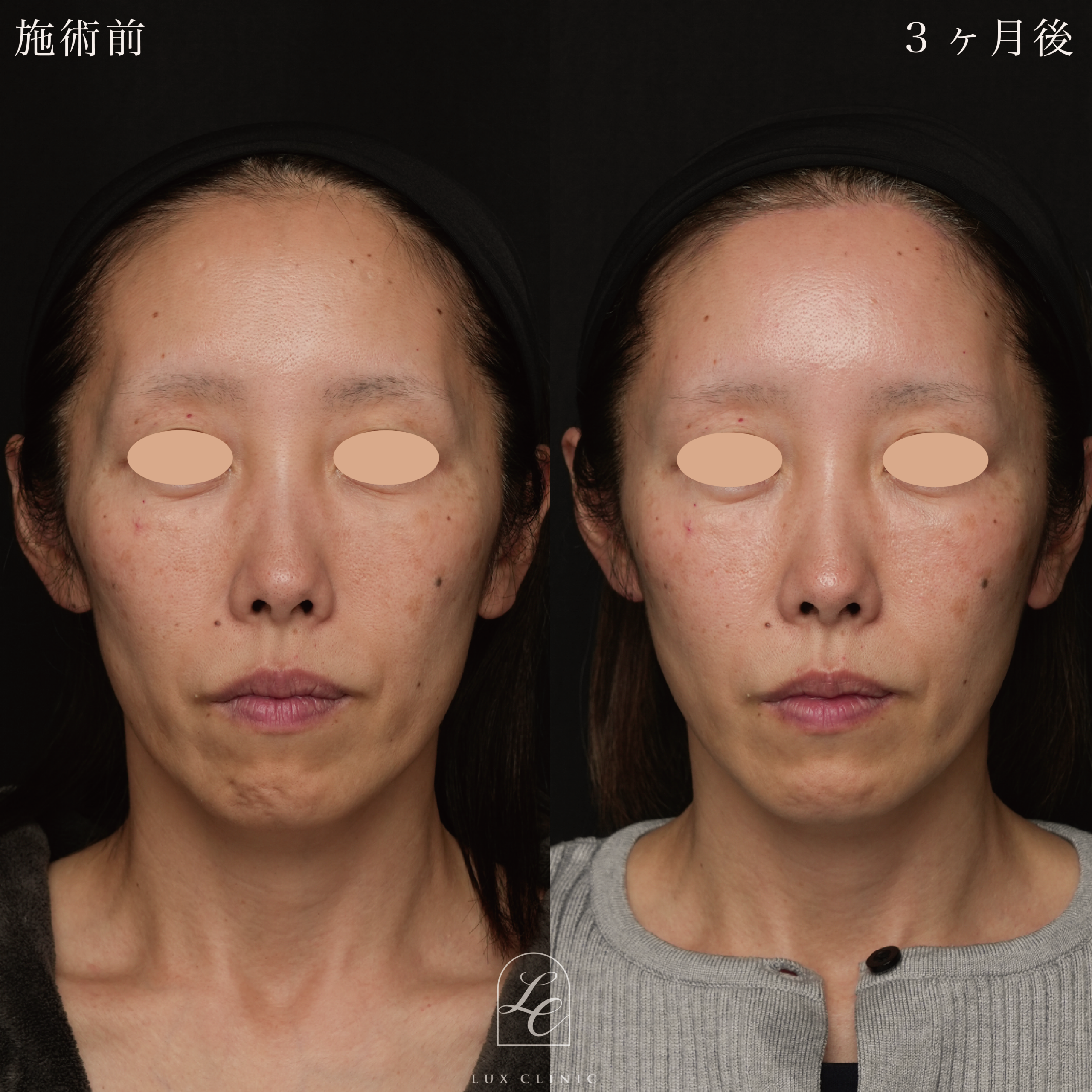 コンデンスリッチ脂肪注入 ＜顔全体・首＞＋前額リフト