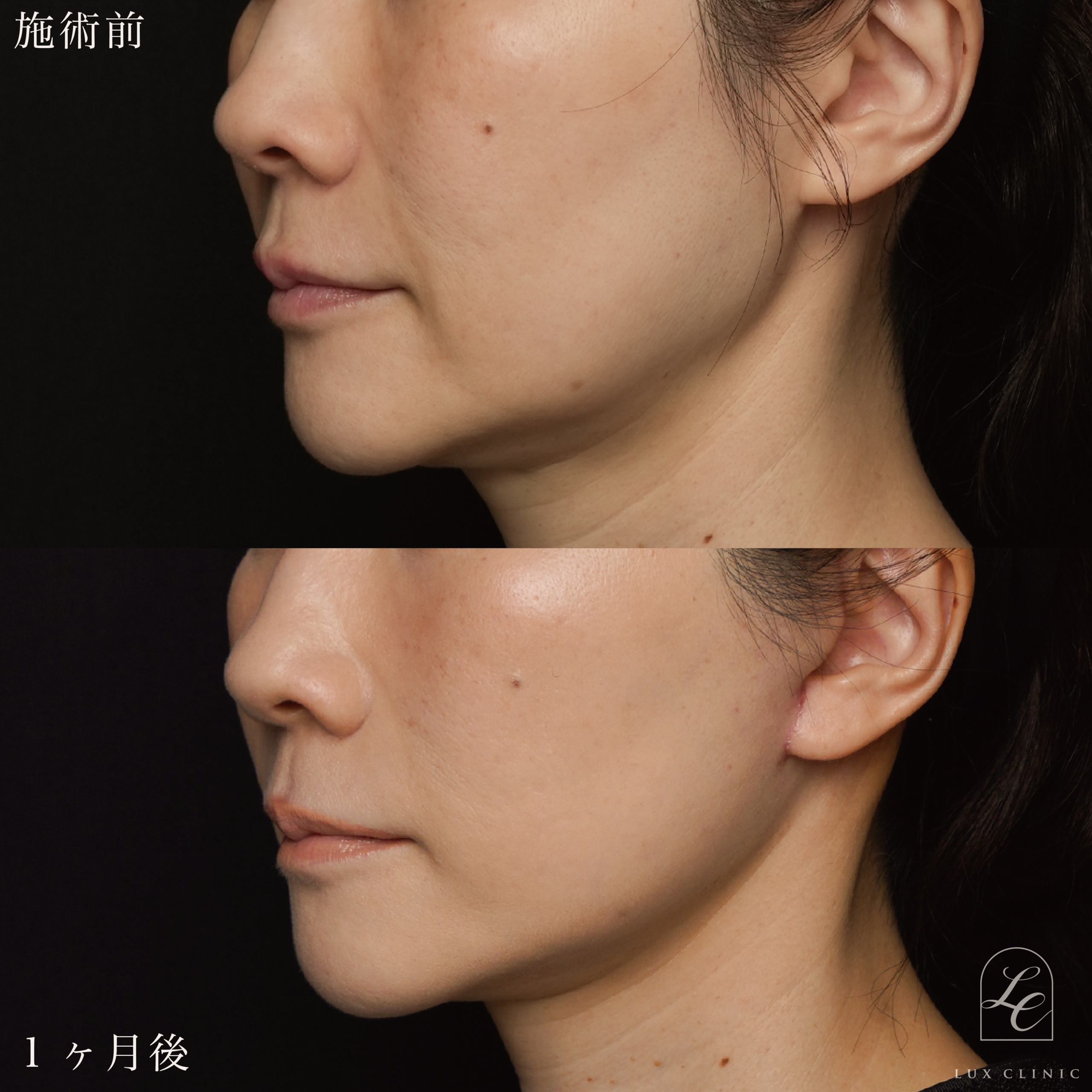 ミニフェイスリフト