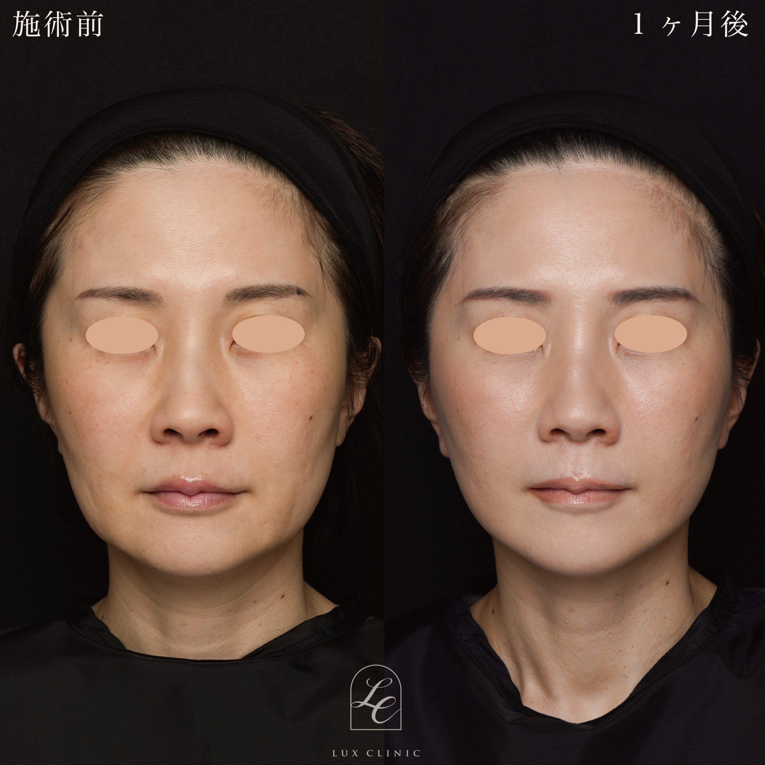 ミニフェイスリフト