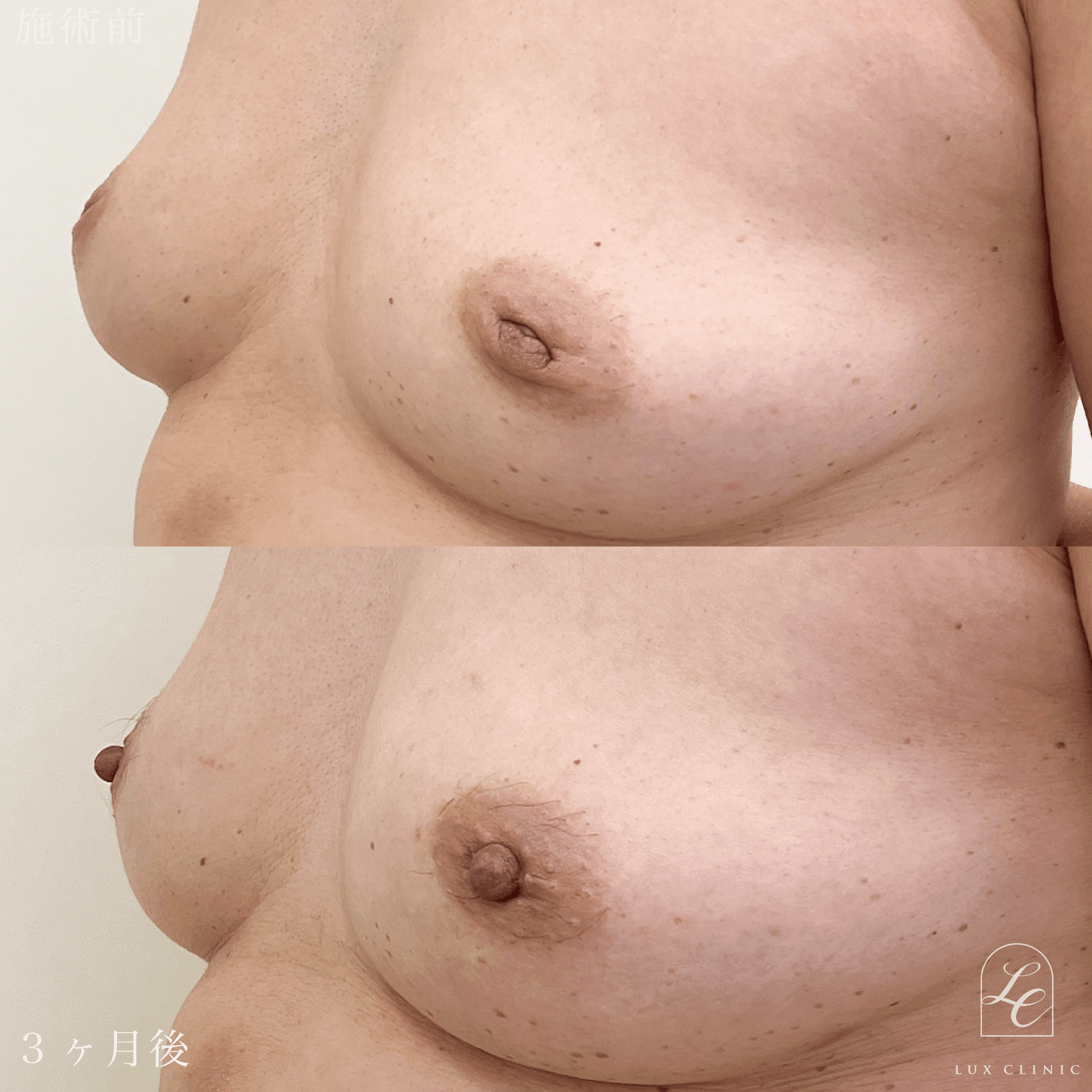 陥没乳頭 ＋ 乳頭縮小術（乳管温存あり）