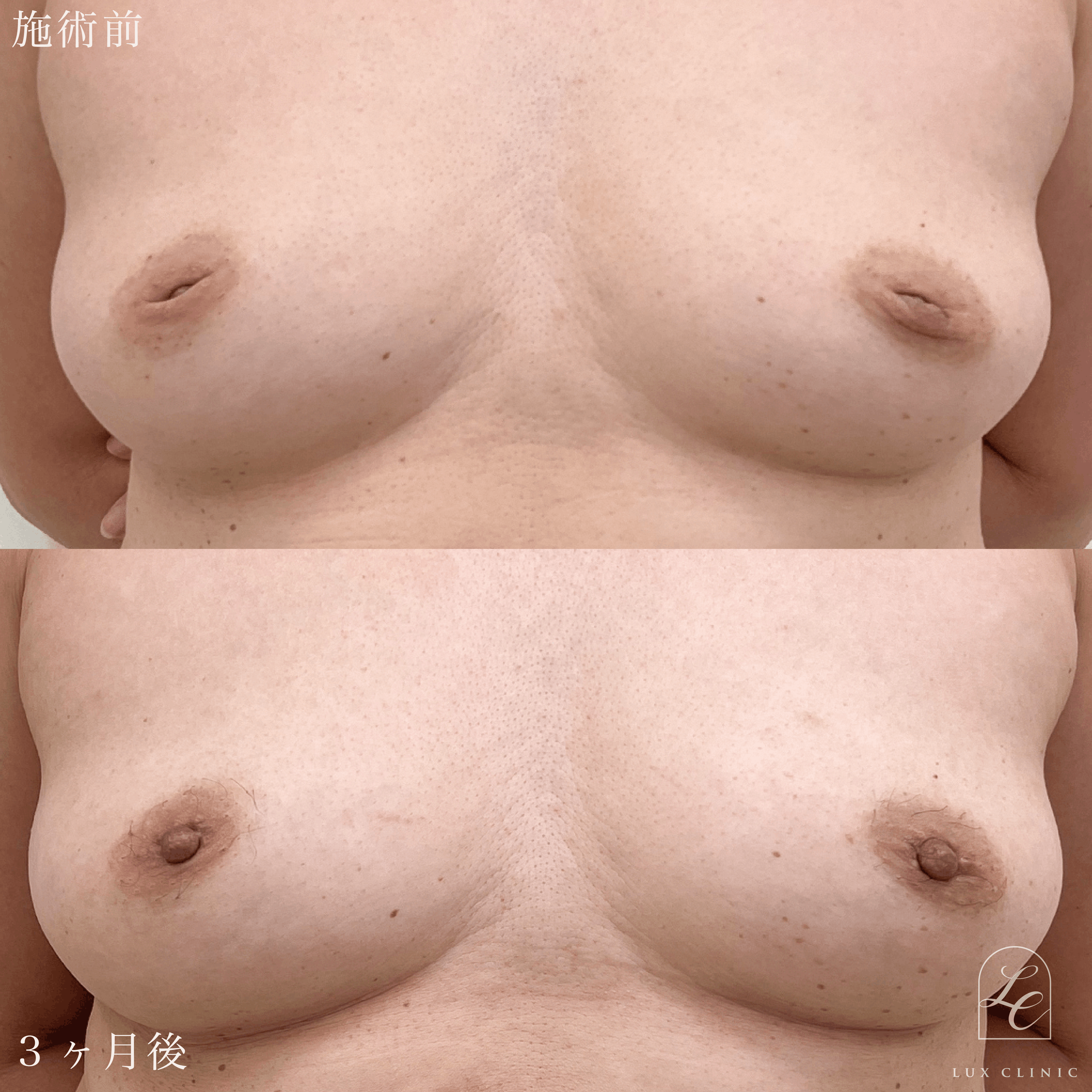 陥没乳頭 ＋ 乳頭縮小術（乳管温存あり）