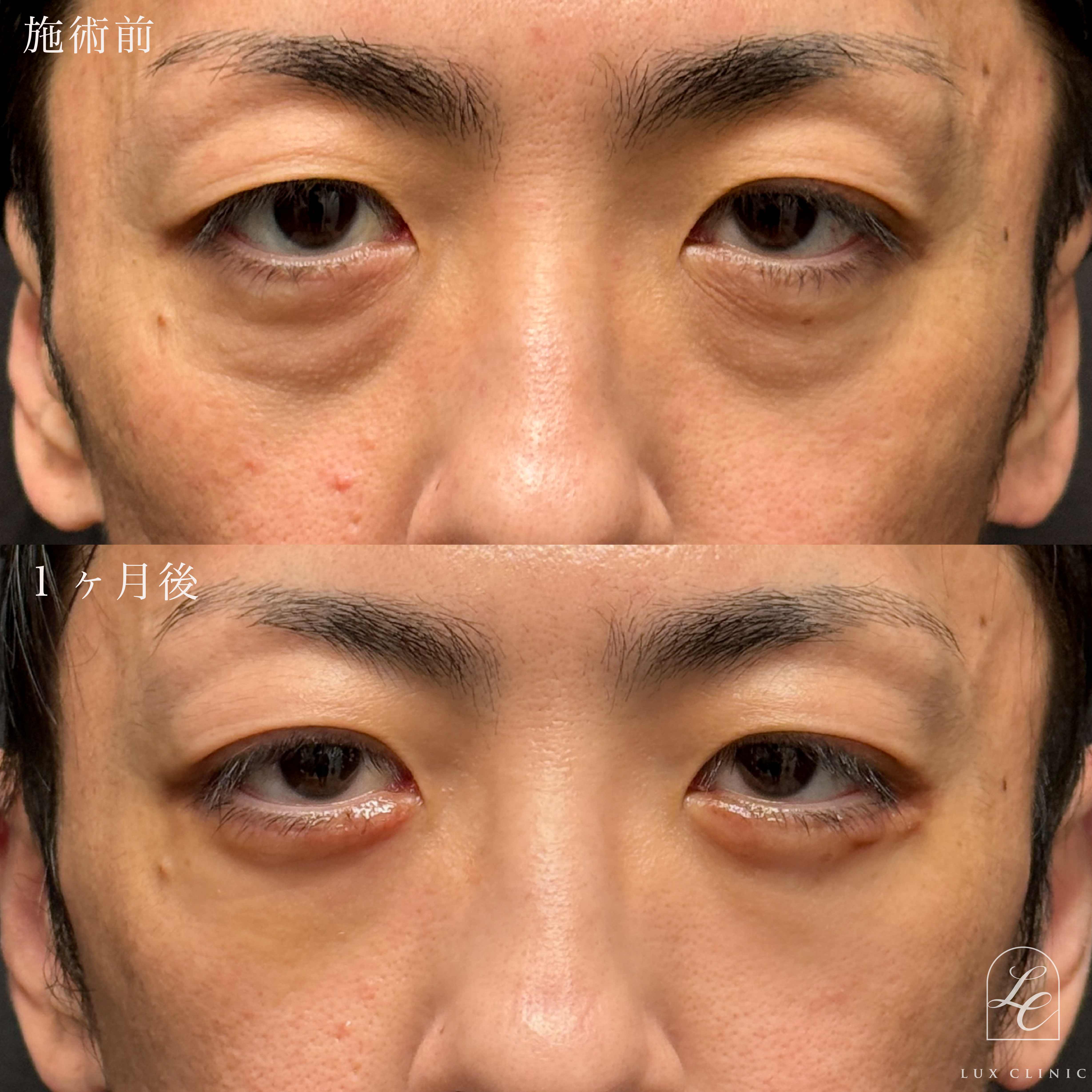 表ハムラ法